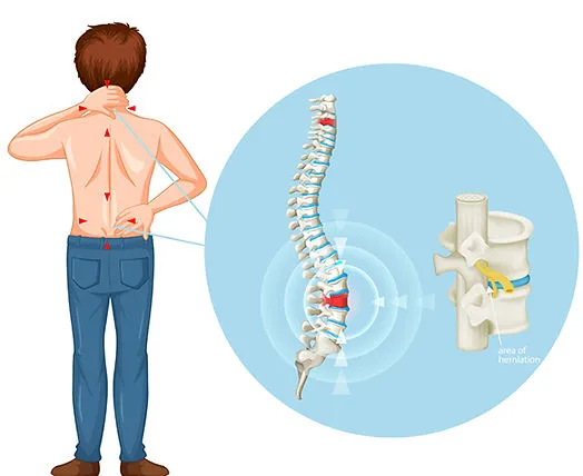 Man with back pain, spinal disc herniation.