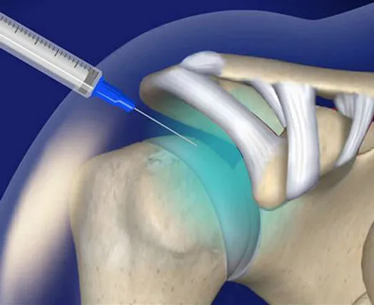 Syringe injecting fluid into shoulder joint.