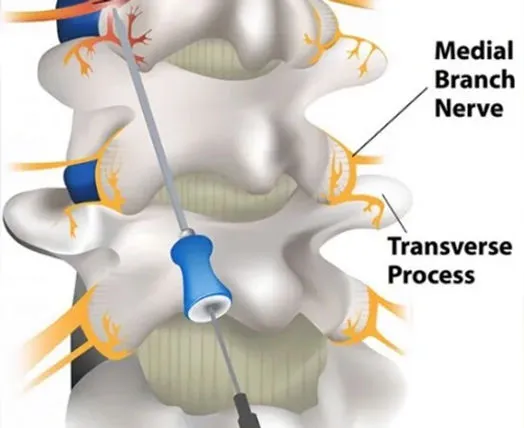 Diagram of spinal nerve and process.