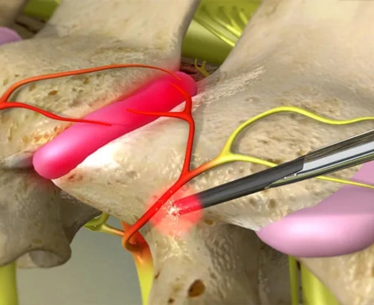 Illustration of spinal nerve ablation procedure.