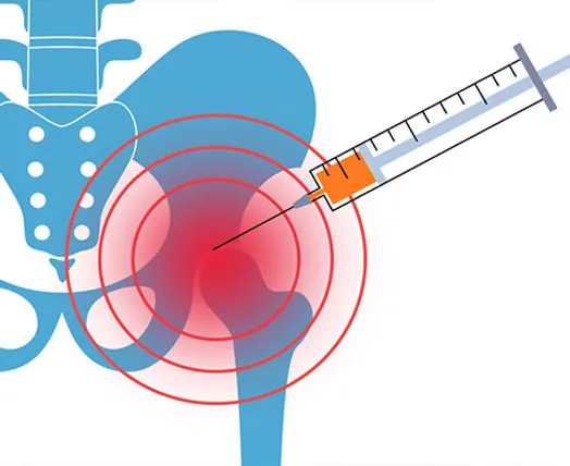 Syringe injecting into painful hip joint.