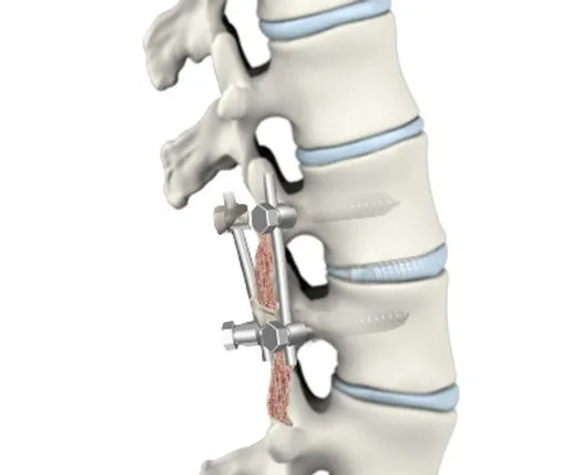 Illustration of spinal fusion surgery.