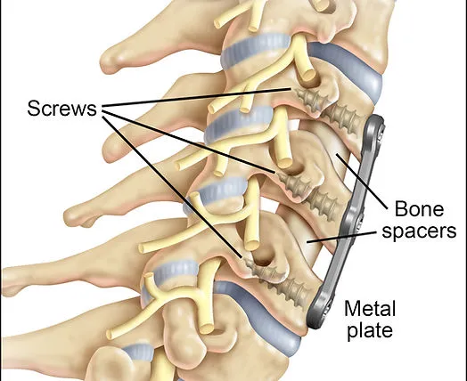 Illustration of spinal fusion surgery.