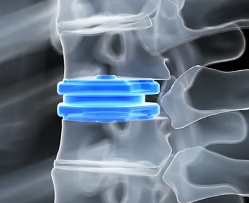 Blue spinal implant in vertebrae.