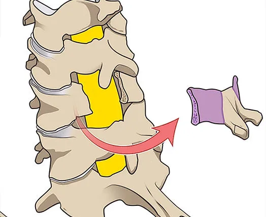 Illustration of a herniated disc in the spine.