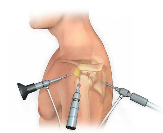 Arthroscopic surgery on a shoulder.