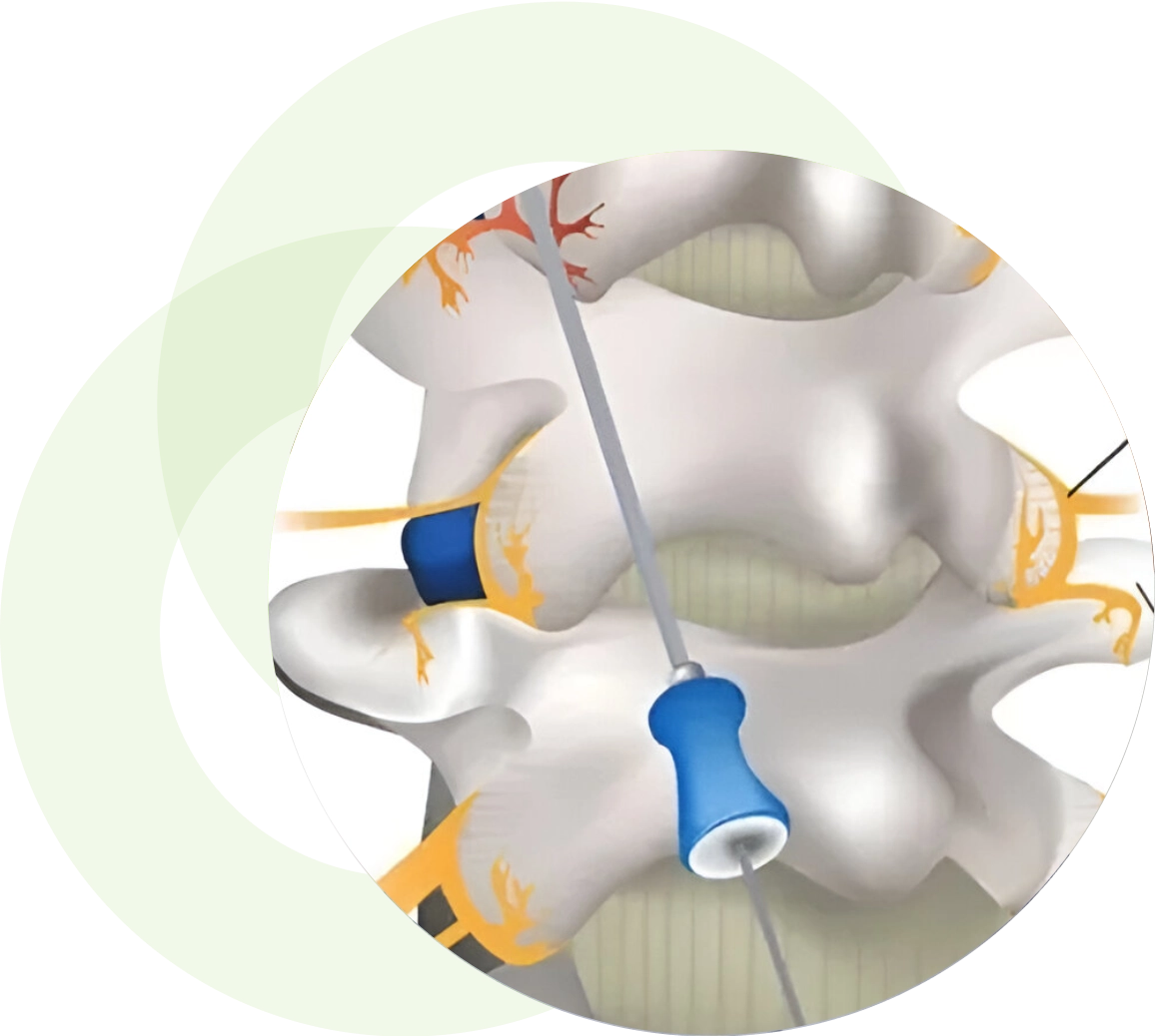 Illustration of a spinal injection.