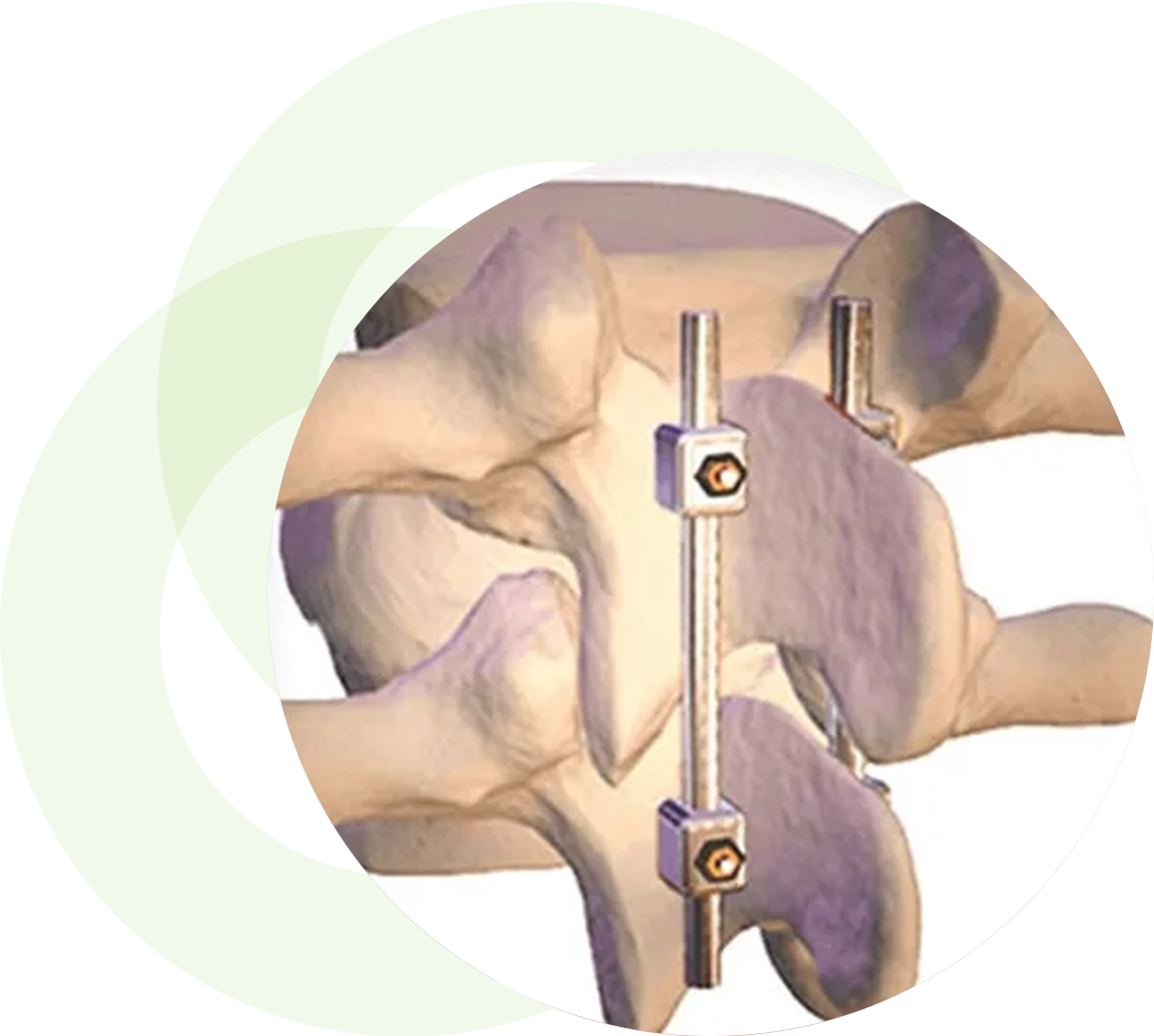 Illustration of spinal fusion surgery.